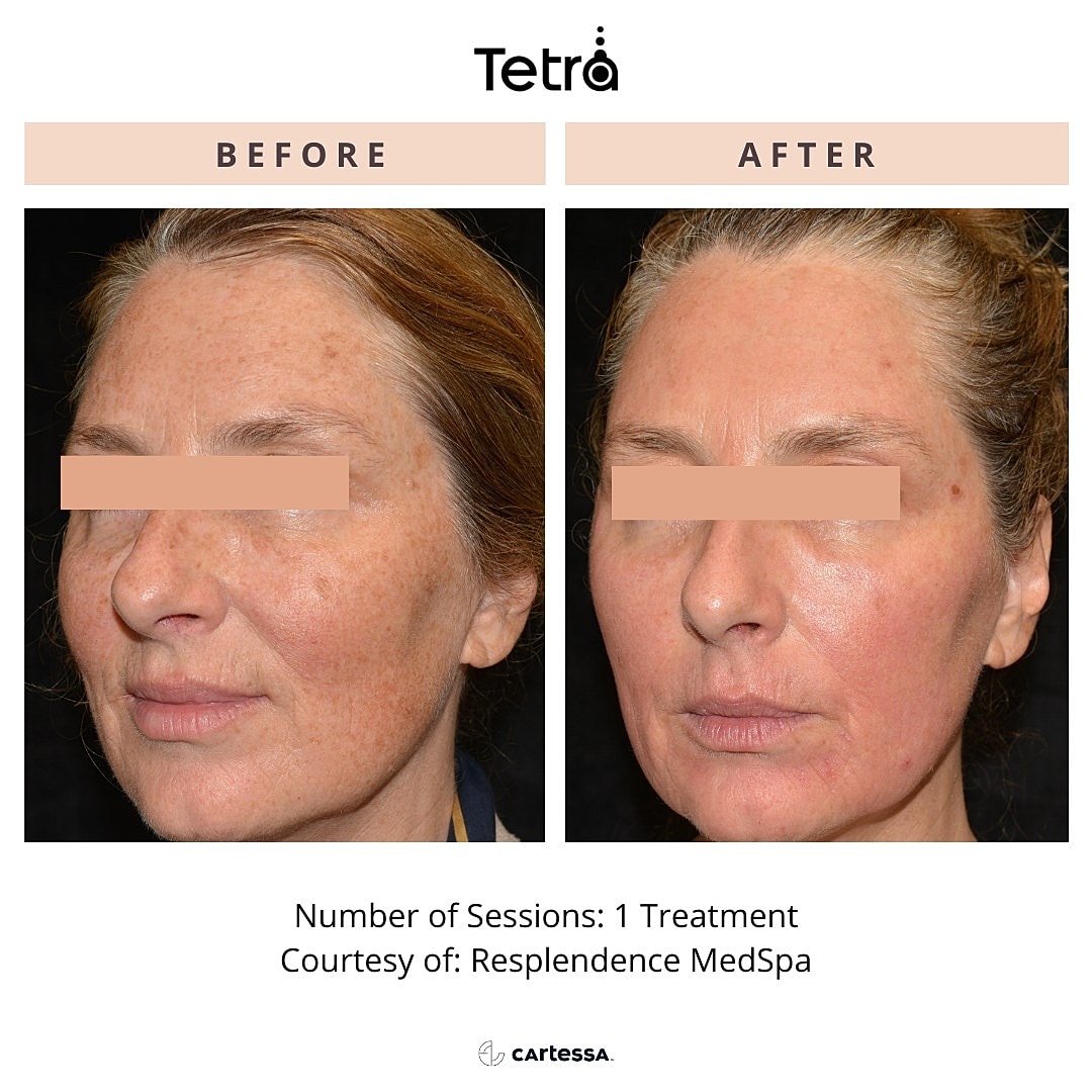 laser-skin-resurfacing-mt-pleasant-tetra