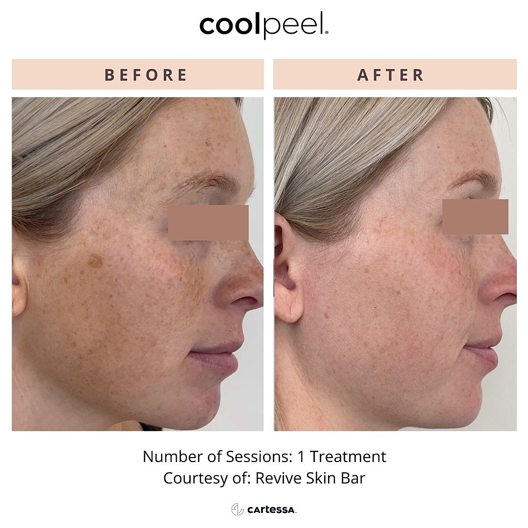 laser-skin-resurfacing-mt-pleasant-cool-peel