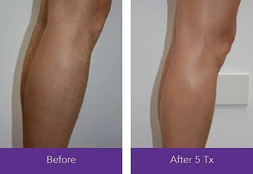 leg-laser-hair-removal-mount-pleasant