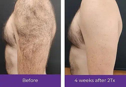 arm-laser-hair-removal-mount-pleasant