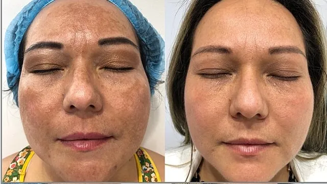 laser treatment for melasma before and after