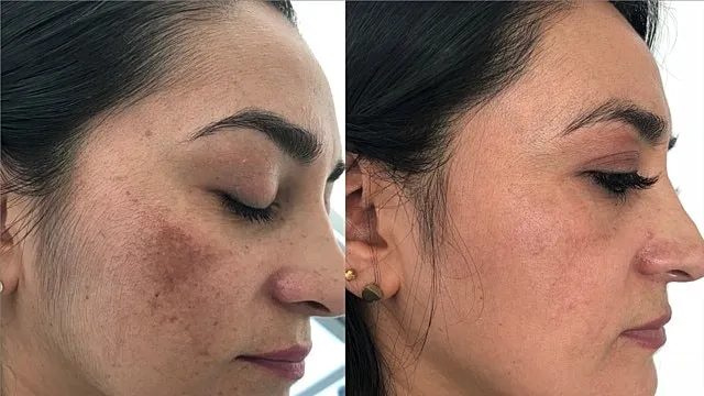 melasma-treatment-before-and-after