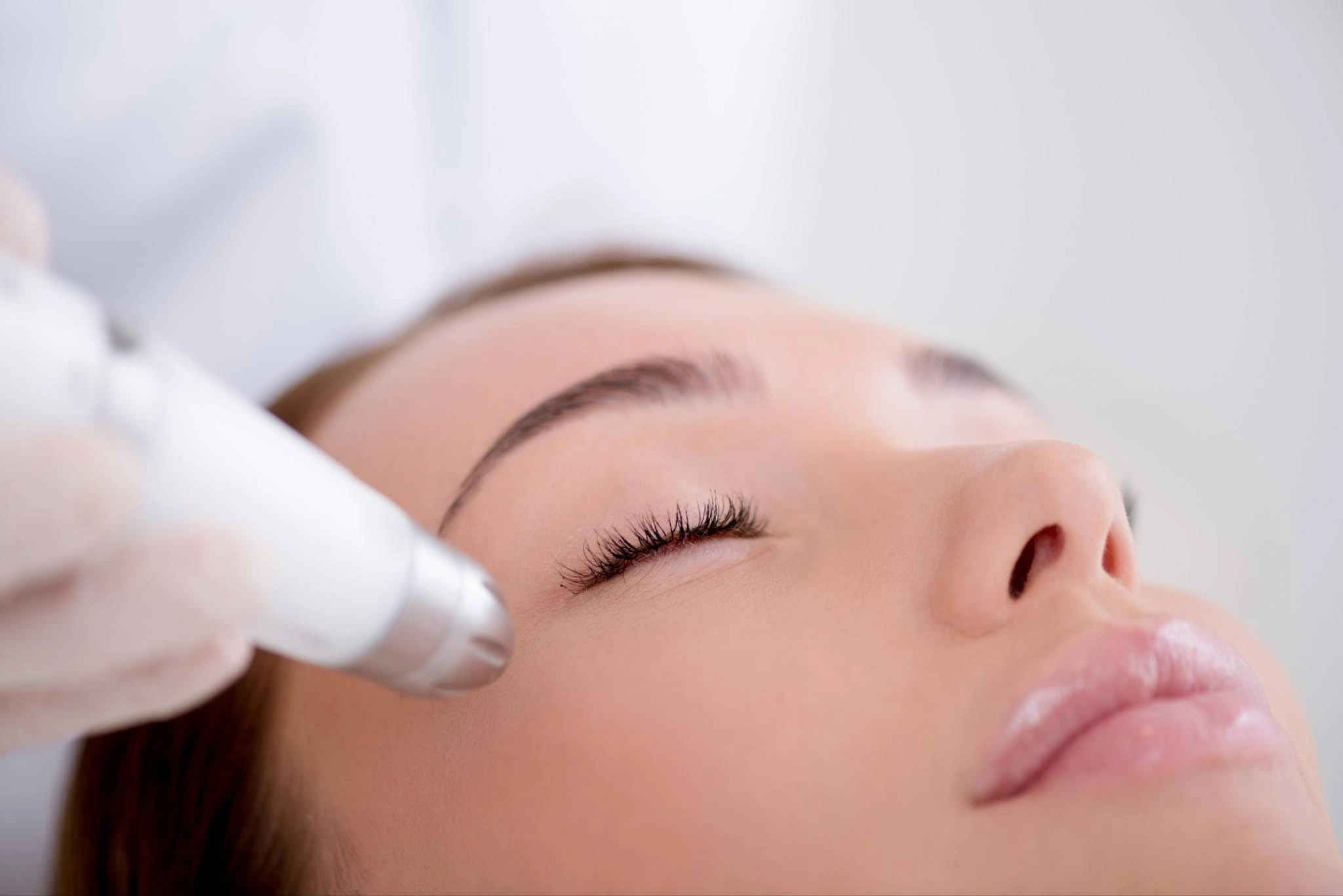 Close-up of microneedling Charleston SC treatment being performed near the eye area